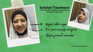 mengatasi pori-pori besar